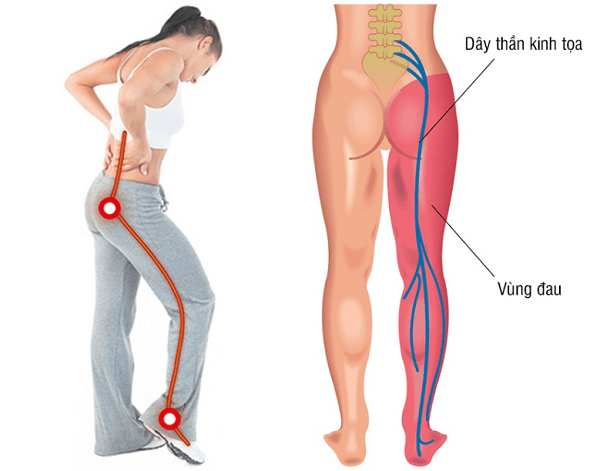 1. Đau Thần Kinh Tọa Là Gì? Triệu Chứng và Nguyên Nhân Gây Bệnh